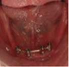 入れ歯が動いて噛みにくい、痛い、といったお悩みがあり、入れ歯を留めるために、インプラントを4本埋入してバーでつなげたところ。