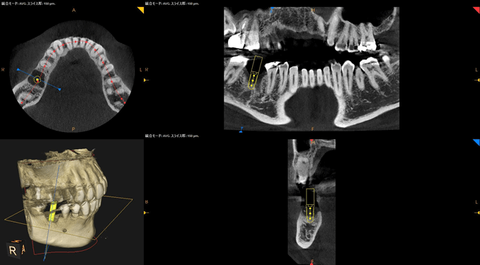 インプラント体をどこに、どの方向で埋入すべきかシミュレーションしています。　歯槽骨の形態、幅、高さを立体的に把握することができます。